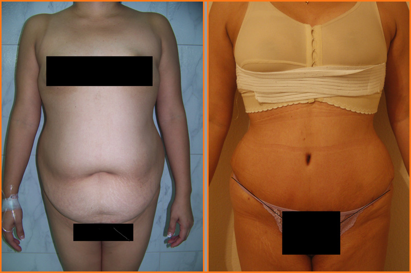 Abdominoplastía