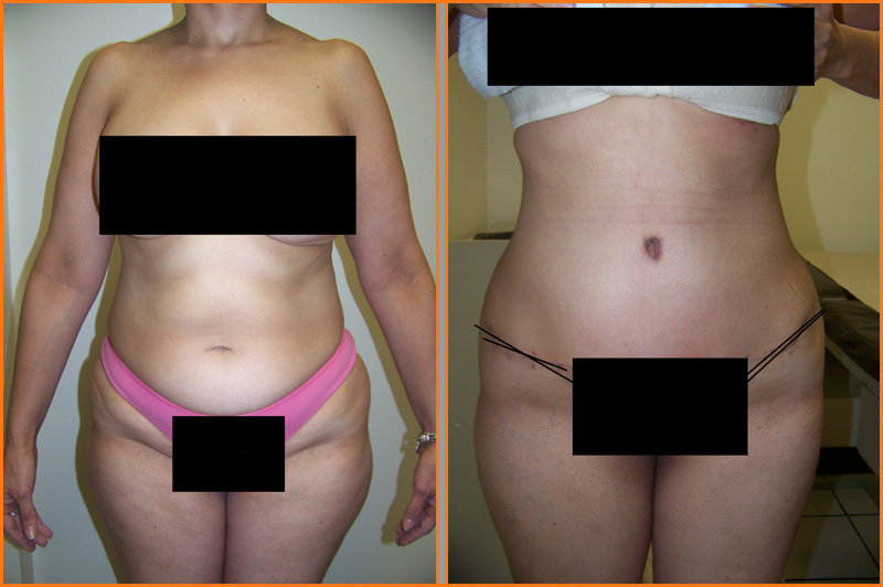 Abdominoplastía