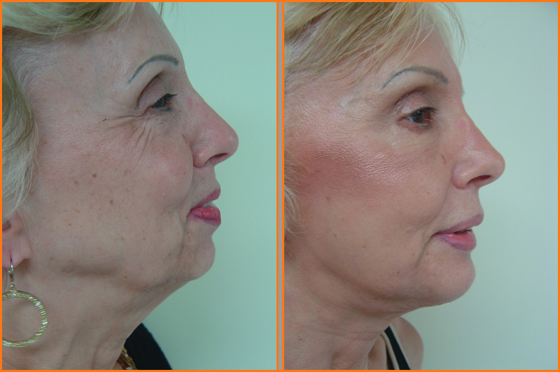 Estiramiento Facial (Lifting)
