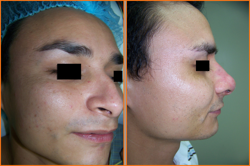 Cirugía de la Nariz (Rinoplastia)