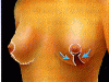 mastopexia3