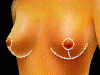 mastopexia4
